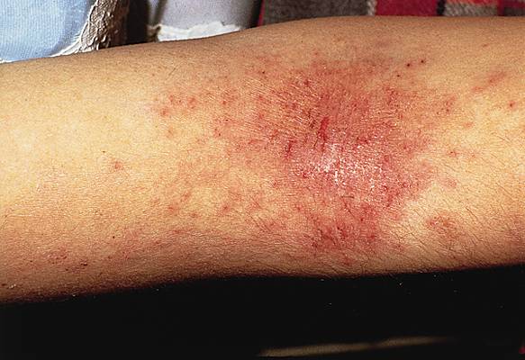 picture of eczema #11