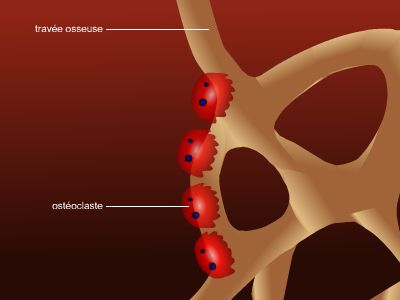 Ostéoporose