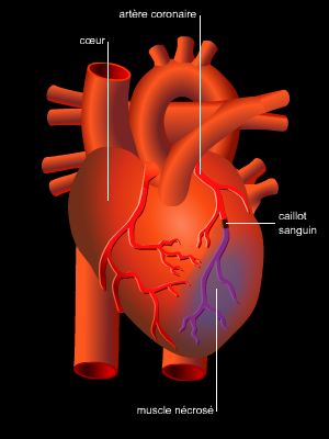 Attaque cardiaque, infarctus du myocarde
