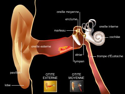 Otite séreuse : une infection de l'oreille à prendre au sérieux - Ideal  Audition