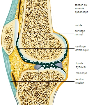 Arthrose du genou