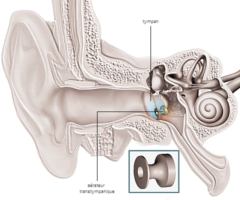 Aérateur transtympanique