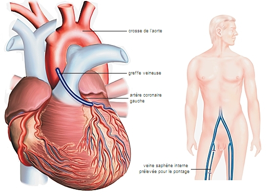 Technique du pontage aortocoronarien