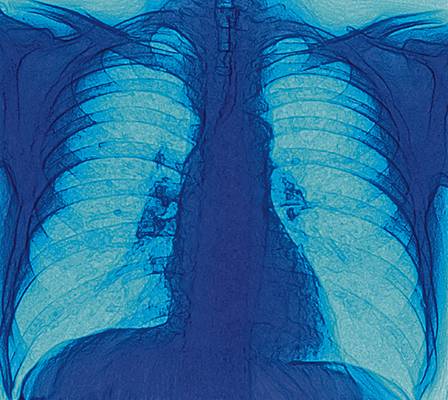 Radiographie des poumons