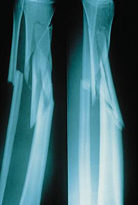 Fracture de la jambe