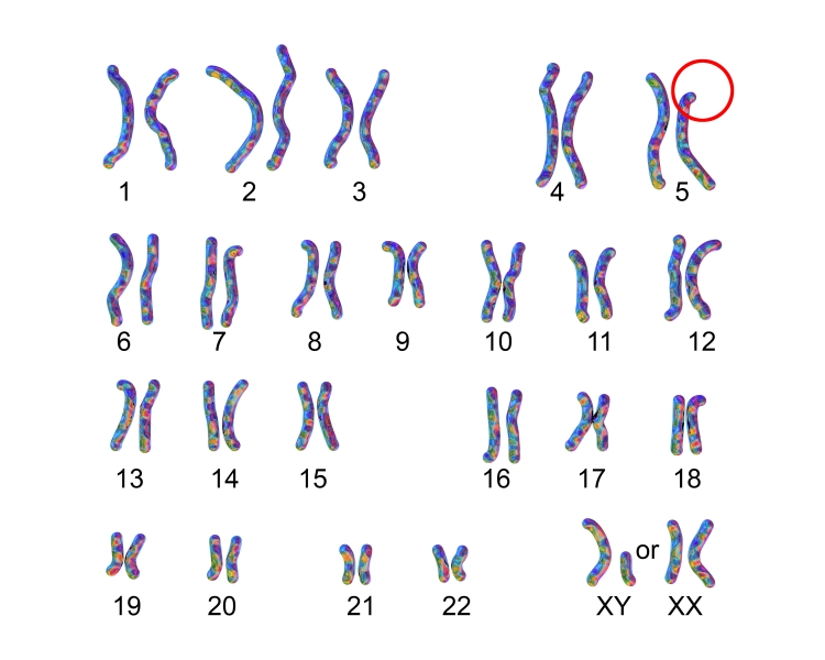 Aberration chromosomique