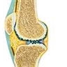 Arthrose du genou
