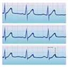 Électrocardiogramme