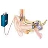 Implant cochléaire Implant cochléaire