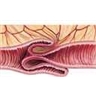 Invagination intestinale