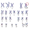 Aberration chromosomique